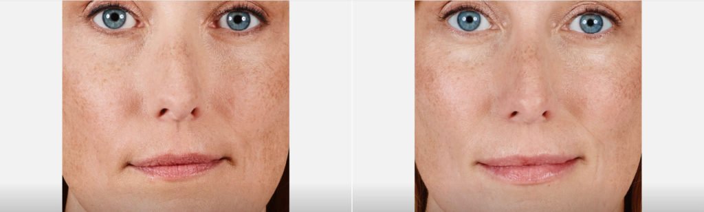 Juvederm Lips Filler Richmond Virginia
