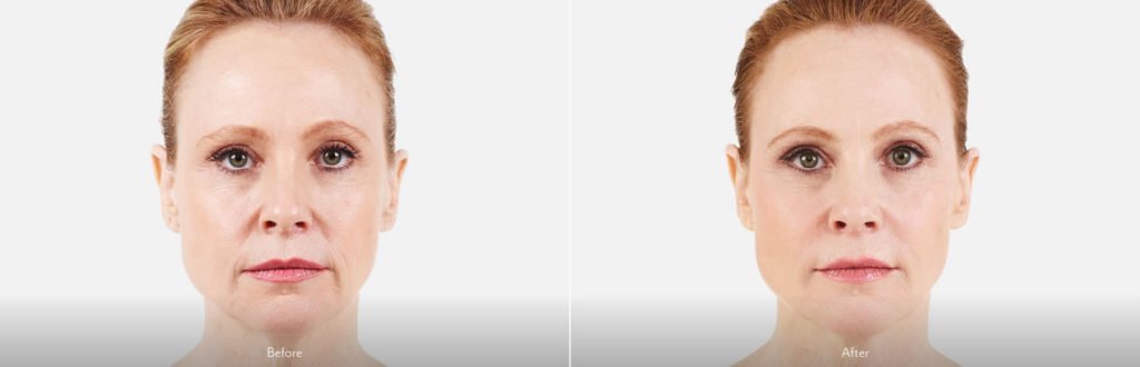 Juvederm Mouth Cheeks Wrinkles Richmond Virginia
