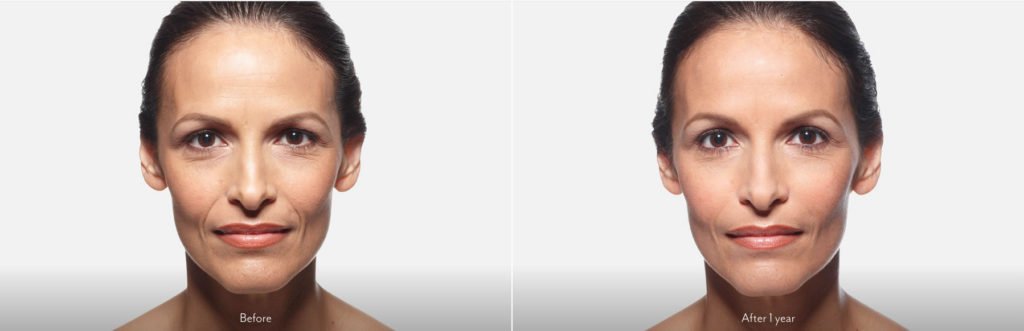 Juvederm Richmond Virginia DeConti