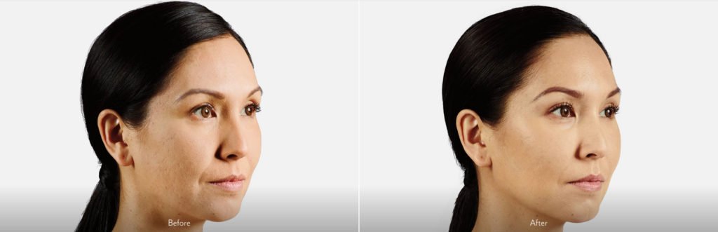 Voluma Juvederm Richmond Virginia DeConti 4